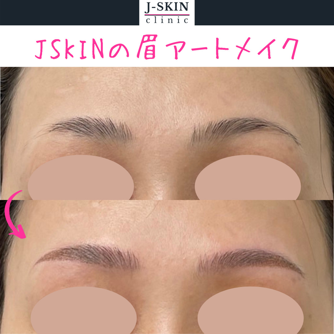 眉アートメイクを受けるメリット・注意点について紹介します - JSKIN